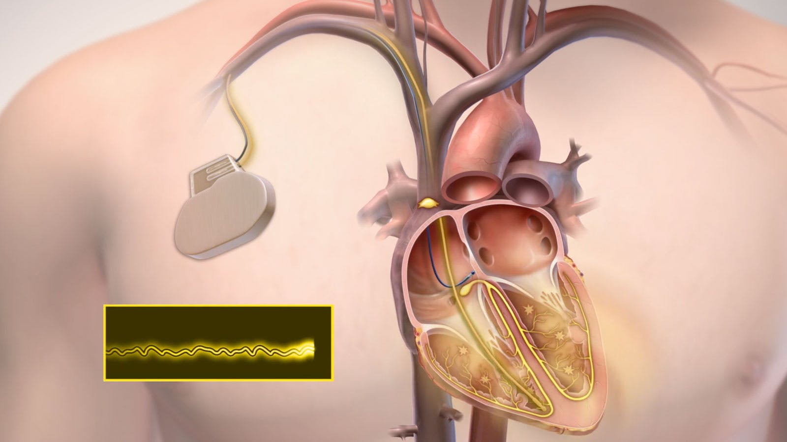 Implantable cardioverter defibrillator (ICD
