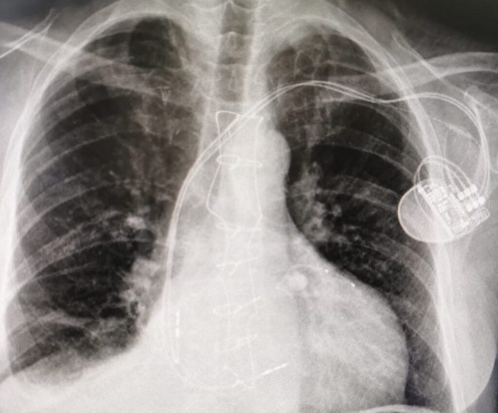 Radiographie du thorax montrant un stimulateur cardiaque et les sondes bien en places