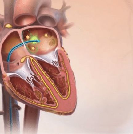 Illustration du cœur en coupe montrant le système de conduction cardiaque et un cathéter intracardiaque – schéma explicatif d’une ablation pour arythmie