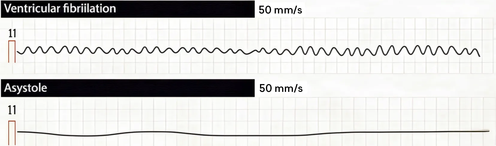 Tracés électrocardiographiques comparant la fibrillation ventriculaire, caractérisée par une activité électrique anarchique, et l’asystolie, ligne plate sans activité, deux mécanismes principaux d’arrêt cardiaque.