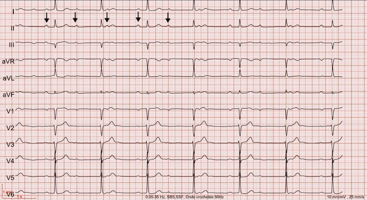 Tracé électrocardiographique illustrant une bradycardie avec ralentissement anormal du rythme cardiaque, utile pour le diagnostic des troubles de conduction comme les blocs auriculo-ventriculaires.