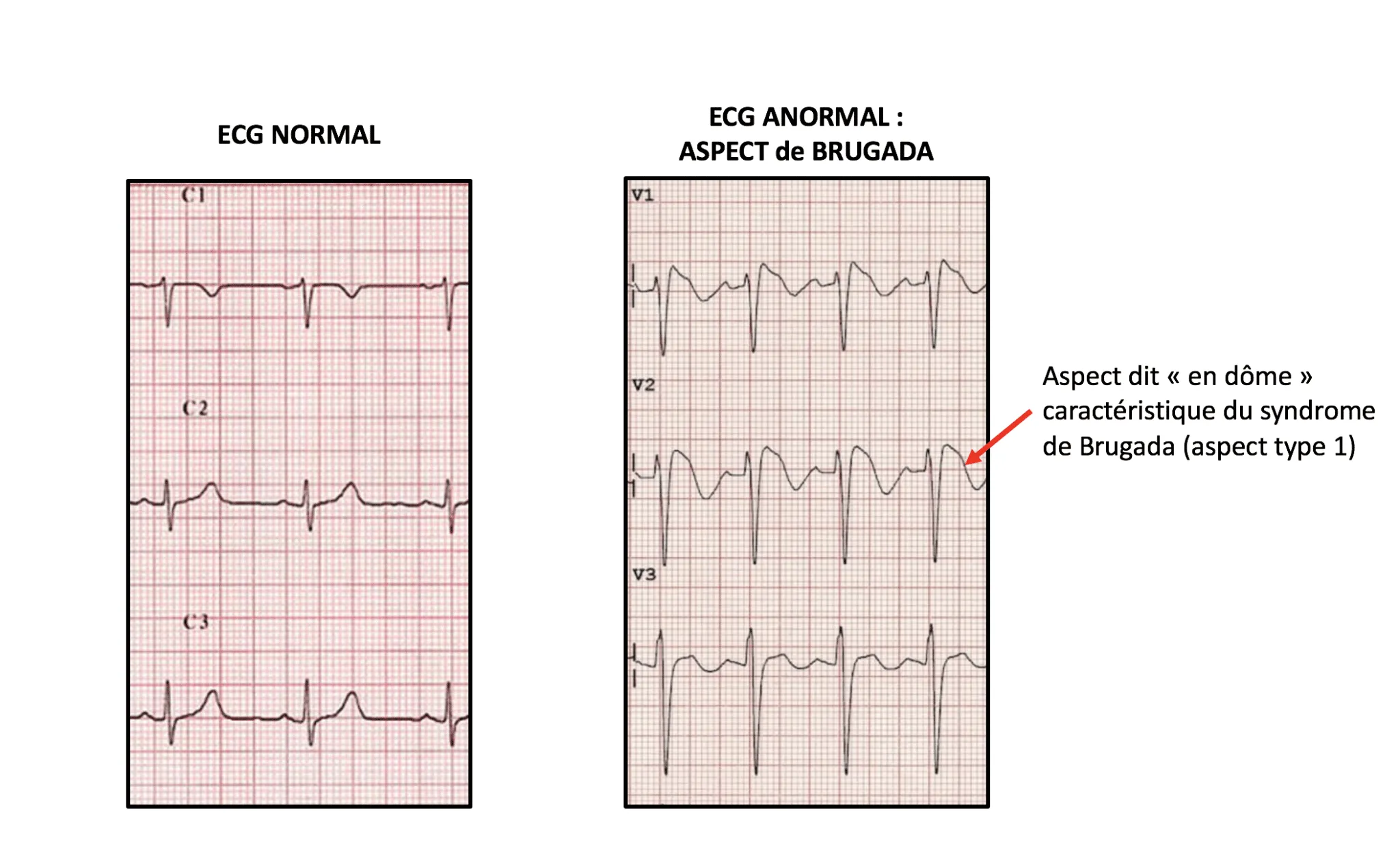 Comparatif d’ECG montrant un tracé normal et un tracé typique du syndrome de Brugada type 1 : élévation du ST en dôme avec onde T négative en V1–V3.