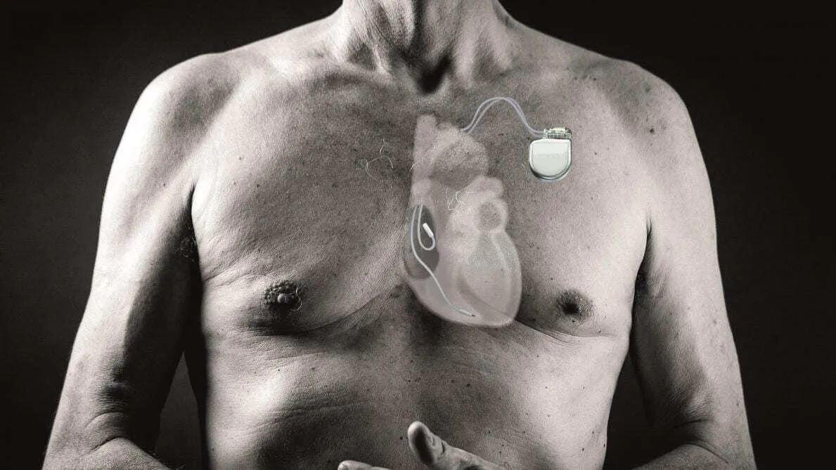 Illustration d’un défibrillateur automatique implantable (DAI) placé sous la peau et relié au cœur, utilisé pour prévenir les troubles du rythme ventriculaire graves.