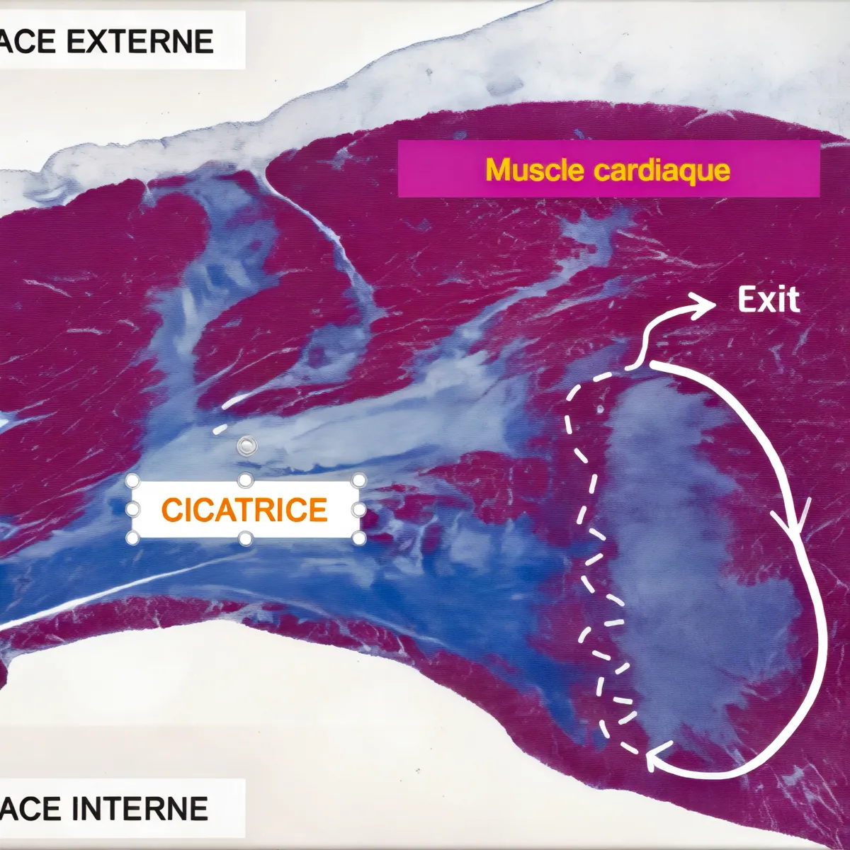 Coupe de muscle cardiaque montrant une cicatrice (fibrose) et le canal lent avec point d’« exit », illustrant le circuit de réentrée responsable des tachycardies ventriculaires post-infarctus.