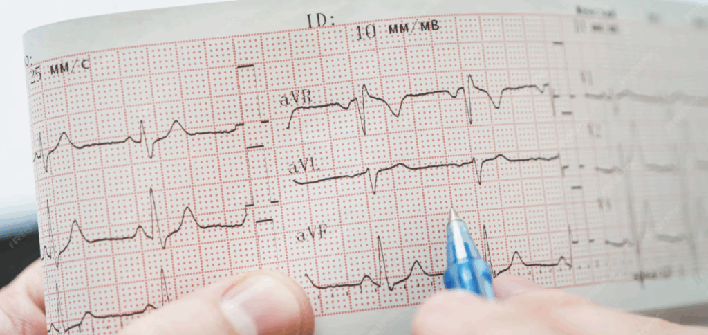 Analyse d’un électrocardiogramme montrant un rythme lent, évocateur de bradycardie
