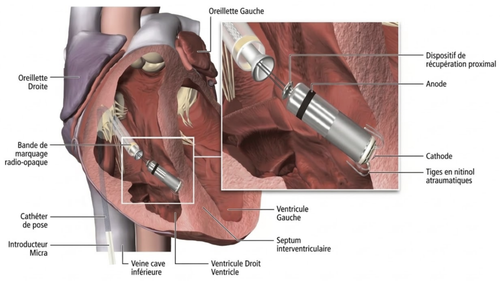implantation d’un pacemaker sans sonde dans le ventricule droit