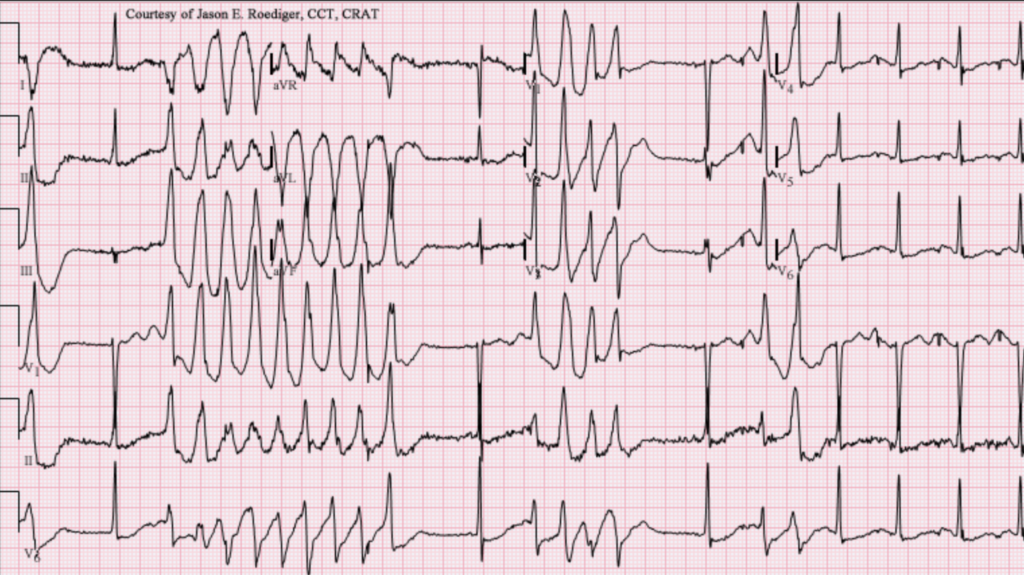 ECG montrant une torsade de pointe avec variation de l’amplitude des complexes ventriculaires