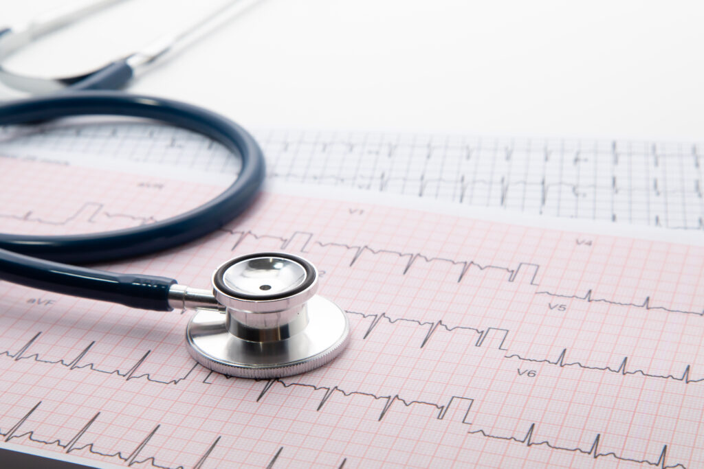 mesure des résultats pour détecter une arythmie