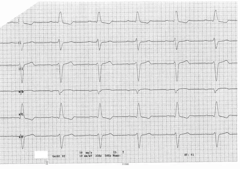 ECG d’un hémibloc antérieur gauche
