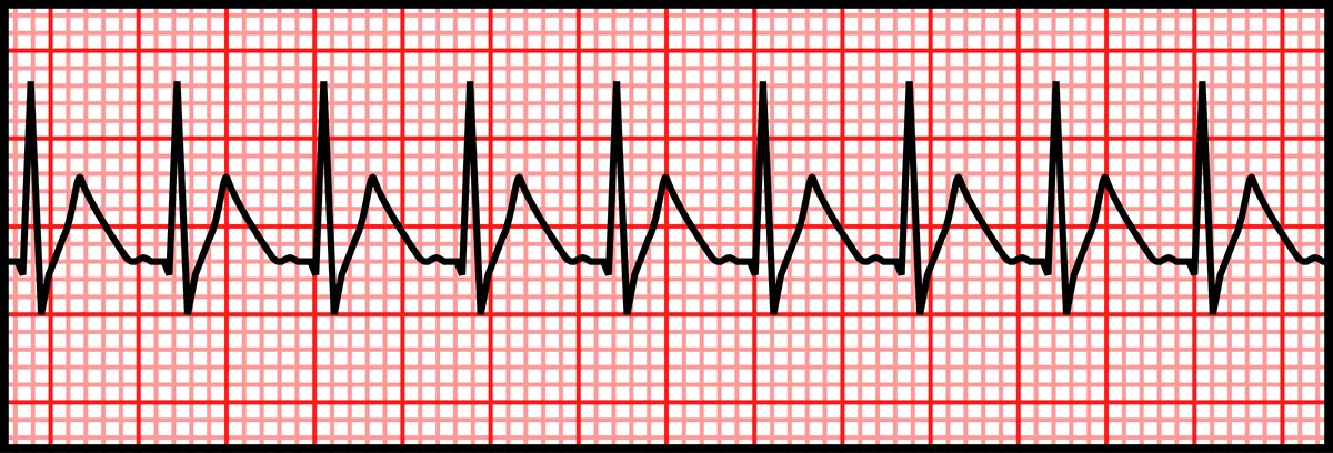 ECG d’une tachycardie supraventriculaire